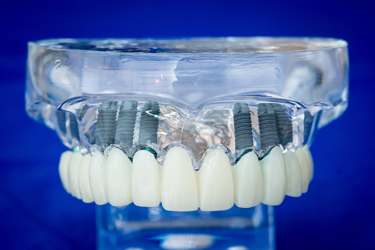 Festsitzende Zähne Implantate