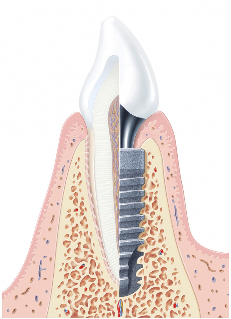 Implantatsystem Dentsply