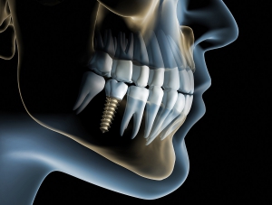 Implantologie - X-Ray Implantat