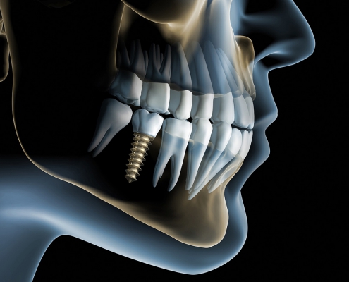 Implantologie - X-Ray Implantat