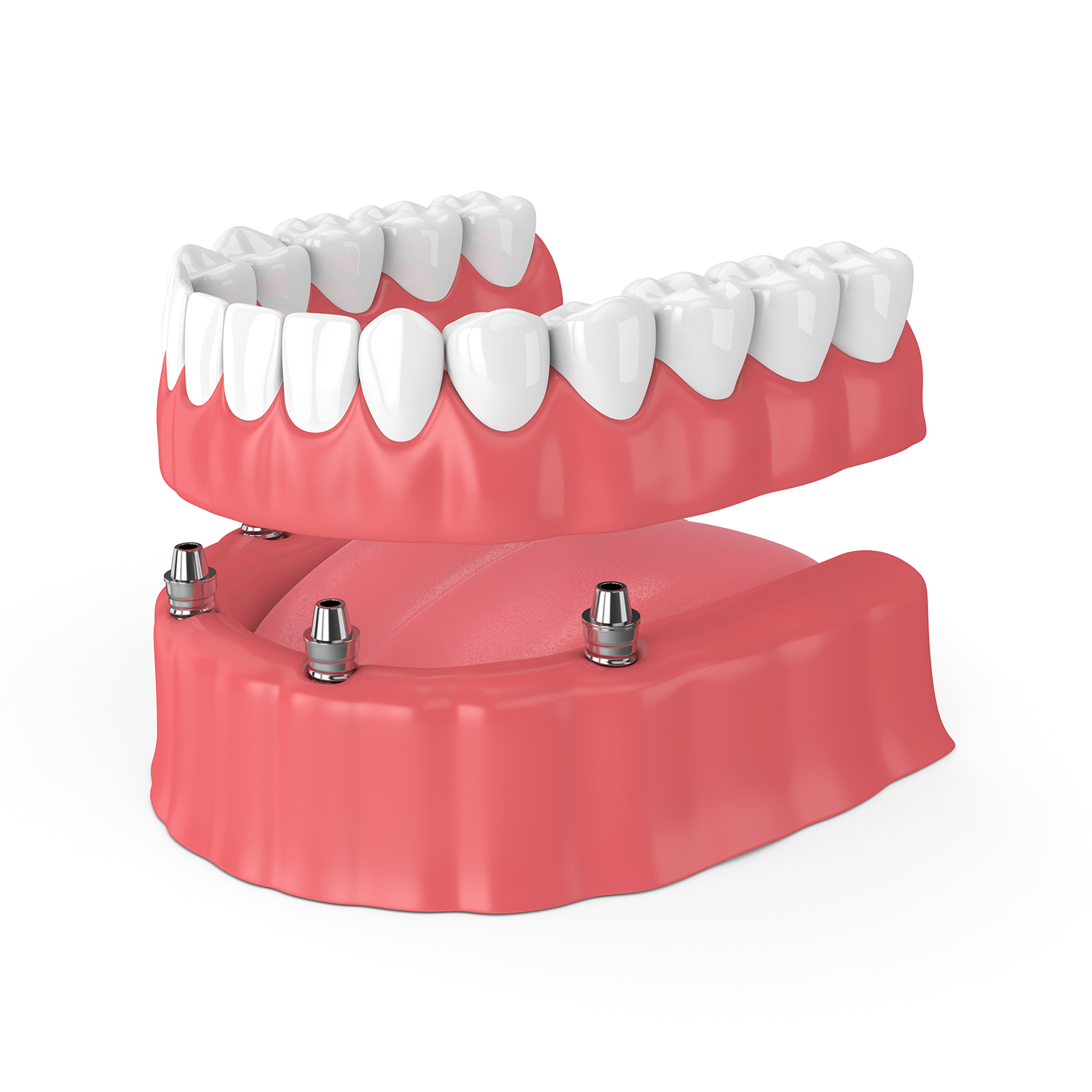 Totalprothese - Implantate