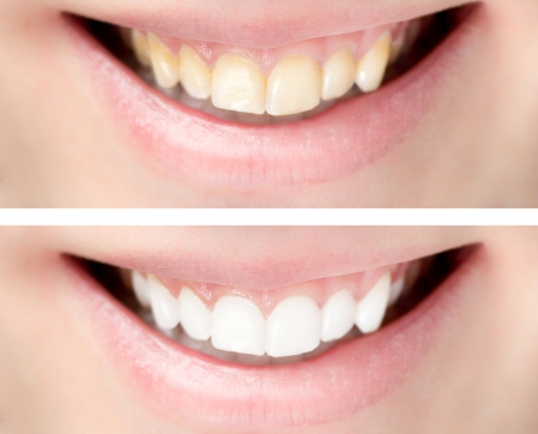 Zahnaufhellung - Vergleich: Vorher/Nachher
